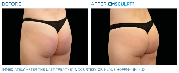 Before & After | EMSCULPT NEO | Dr. Patricia L. James