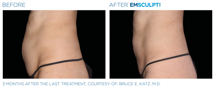 Before & After | EMSCULPT NEO | Dr. Patricia L. James