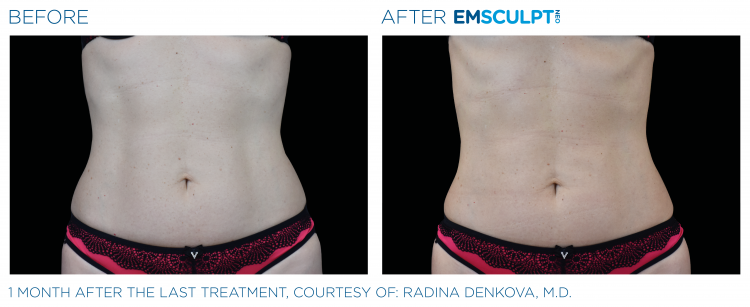 Before & After | EMSCULPT NEO | Dr. Patricia L. James